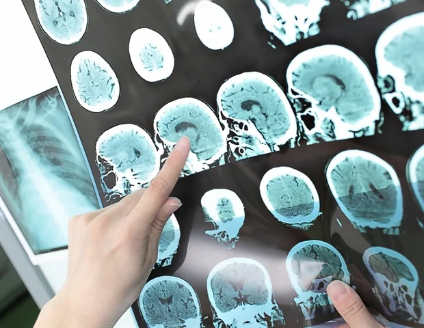 Pasien imigran di Kanada jalani perawatan ICU lebih lama setelah terkena stroke