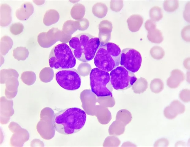 Pasien acute myeloid leukemia mendapatkan manfaat dari terapi kombinasi azacitidine dan venetoclax