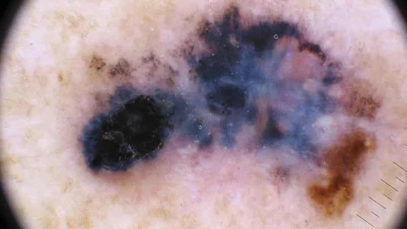 Vaksin kanker personalisasi Moderna dan Merck beri harapan baru bagi pasien melanoma